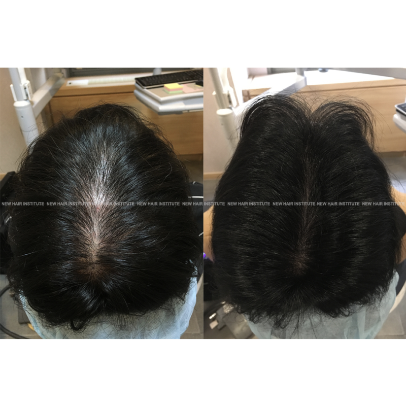 두피 여포 주사 검토 파트 1:: 화이자 부작용