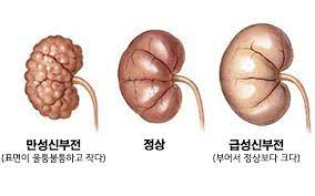 만성신부전CRF 원인진단 증상투석이식치료 식이요법합병증 간호진단케이스 문헌고찰 만성신부전CRF 원인진단 증상투석이식치료 식이요법합병증 간호진단케이스 문헌고찰