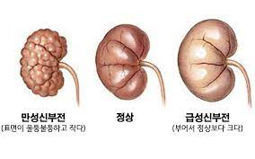 만성신부전CRF 원인진단 증상투석이식치료 식이요법합병증 간호진단케이스 문헌고찰