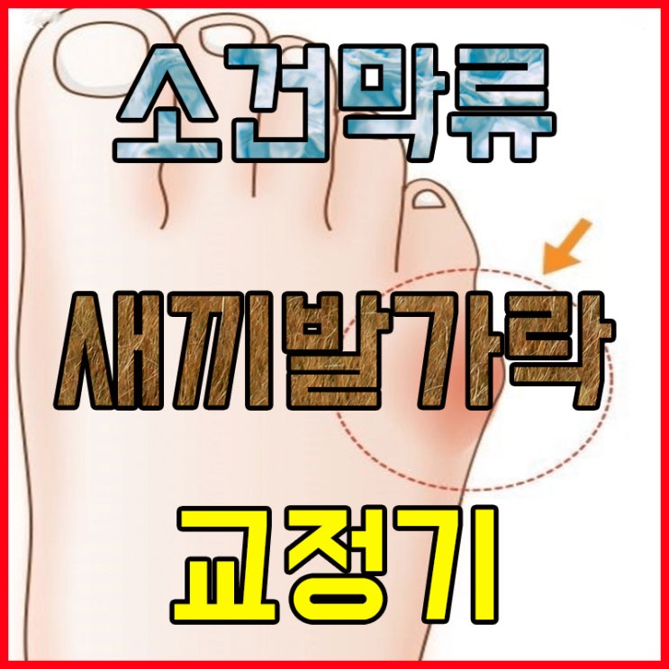  소건막류 새끼발가락 교정기로 증상 예방하기