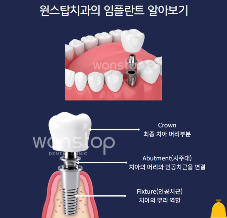  범계임플란트? 잘하는 치과 찾는 2가지 방법