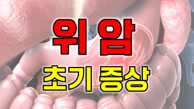  "혹시 위암 아닌가요?" 놓치기 쉬운 위암 초기증상 5가지
