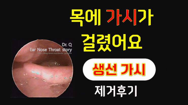  "목에 가시가 걸렸어요" 45세 여자 - 생선가시 제거 후기