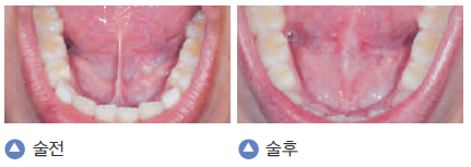 엑소 첸이 플루트를 잘 부를려고 받은 수술? / 파리넬리 수술, 설소대 제거 수술, 크라운 임플란트 치아교정등의 수술이 미치는 영형에 대하여