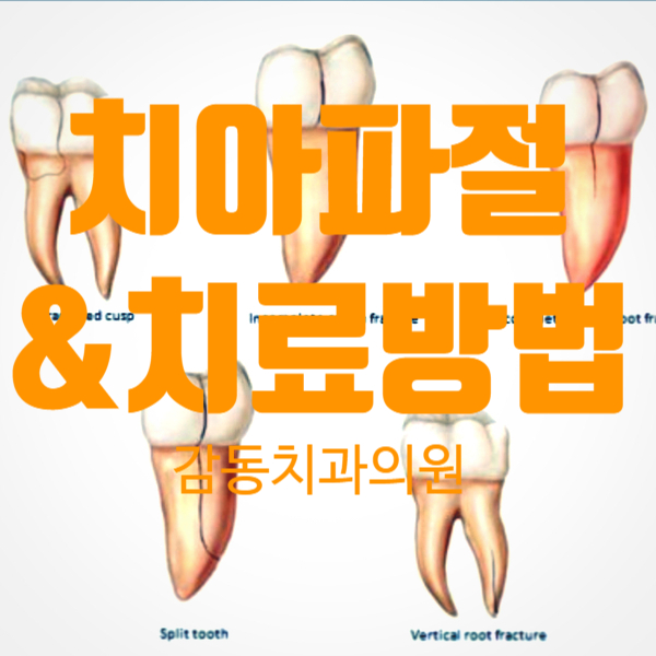  치아가 금이 가고 깨졌어요 치아 파절과 치료방법
