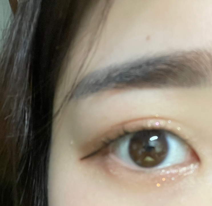  점막점(특수점) 제거 2주차 후기