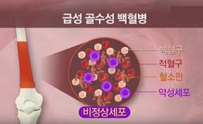  백혈병 급성만성 골수성림프성 약물치료 골수이식:예후합병증 간호진단케이스 문헌고찰