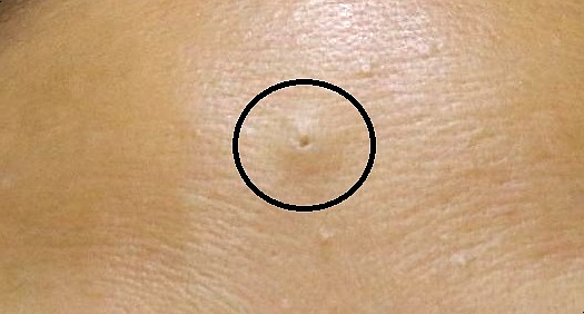  광주 피지낭종, 이거 모르면 치료받고도 재발한다?