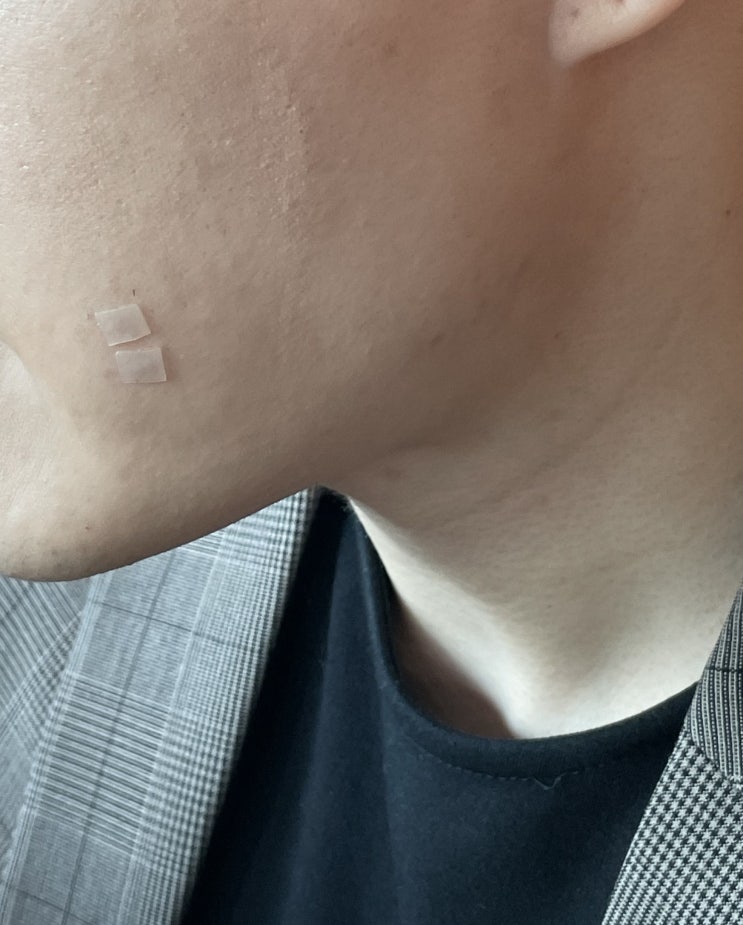  상처에 흉터밴드 방수밴드 자외선 차단까지 되는 레노덤