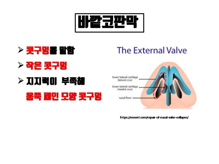  코수술 시 콧구멍(비공)이 크다고 너무 줄이면 코수술 후 코막힘의 원인이 될 수 있어요!!!