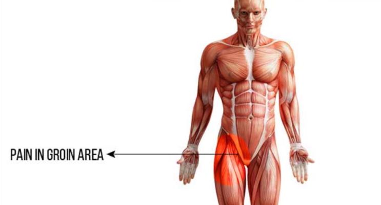  [서래마을 PT] 사타구니 통증 Groin Pull (Adductor strain)