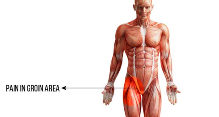 [서래마을 PT] 사타구니 통증 Groin Pull (Adductor strain)