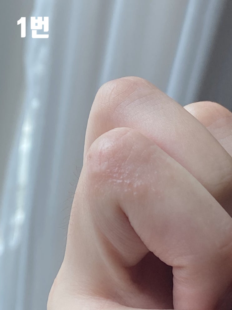  손등수포 호전 손가락물집수포 여전 자세한 후기(디푸코연고)