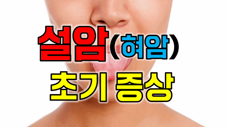  "혹시 설암 아닌가요?" 꼭 알아야할 설암(혀암) 초기증상 5가지