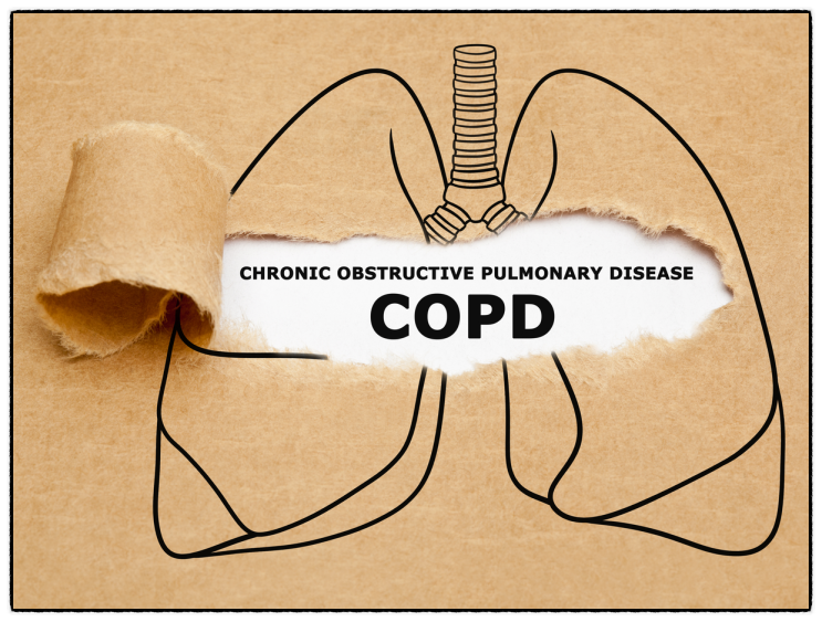  만성 폐쇄성 폐질환을 알리는 위험신호, 줄기세포보관의 중요성을 다시 조명한다.