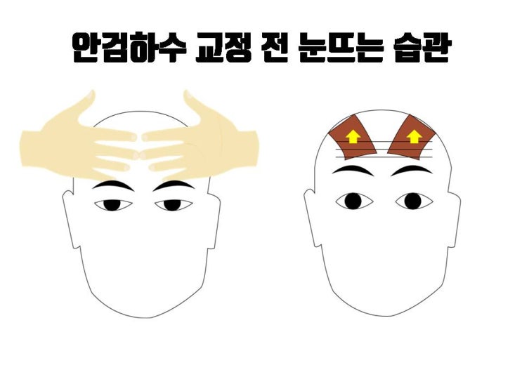  쌍수 후 눈뜨기 운동은 도움이 안 돼요. 눈매교정 후 제대로 눈뜨는 연습을 하셔야 해요!!!