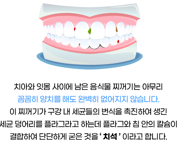 [5월, 6월 이벤트 ] #2. 스케일링 (두 달간만 진행 /우리 치과)