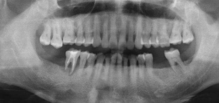 치근파절시 임플란트 치료 방법과 과정 (응암역 치과)
