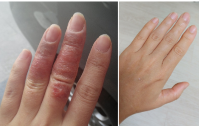  손습진 손한포진 연고없이 홈케어로 건강해진 후기