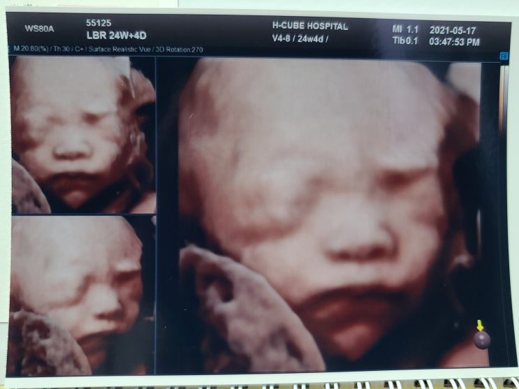 [임신24주] 에이치큐브병원 임당검사 + 입체초음파 후기