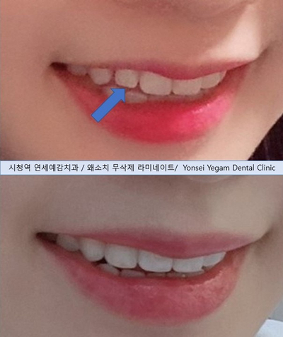  [광화문]라미네이트/무삭제 프리네이트 케이스(벌어진치아,충치,옥니,치아모양개선,왜소치)
