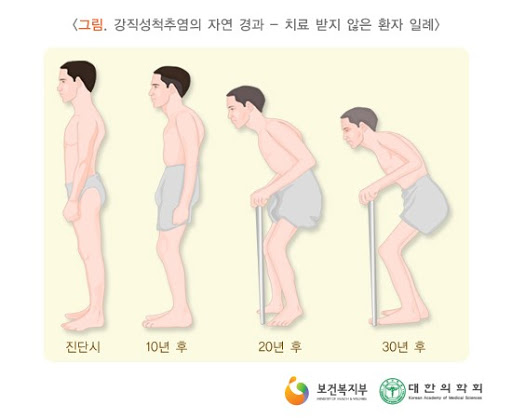  [이수역필라테스] 강직성 척추염(Ankylosing Spondylitis) 관련 편
