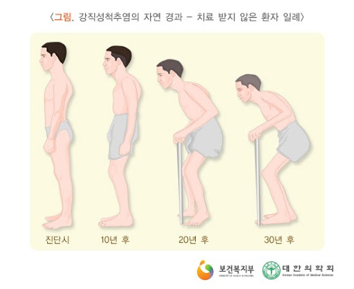 [이수역필라테스] 강직성 척추염(Ankylosing Spondylitis) 관련 편