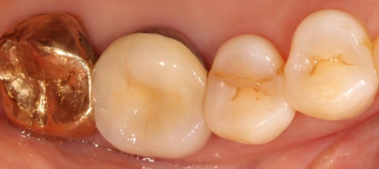 금이 간 치아(균열치아) 및 신경치료 (응암역 치과)