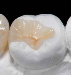 [문정역 치과]CEREC 세라믹 인레이 및 레진 치료 - 기존 아말감 충치, 치간 충치 치료 5