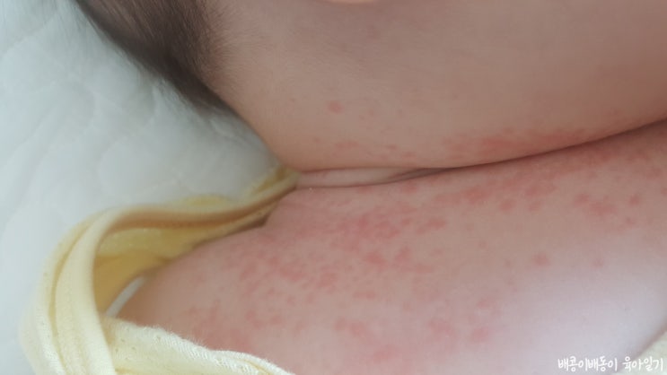  아기땀띠 진정 관리가 중요 아토엔비 수딩젤 추천