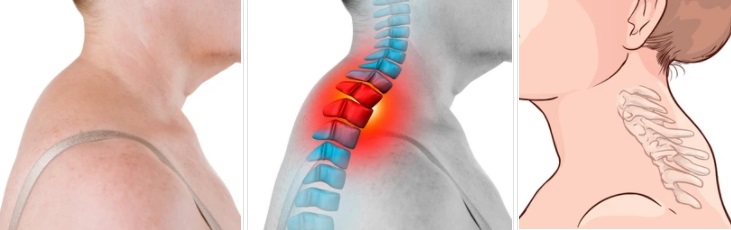  버팔로험프(Buffalo hump), 버섯증후군이란?