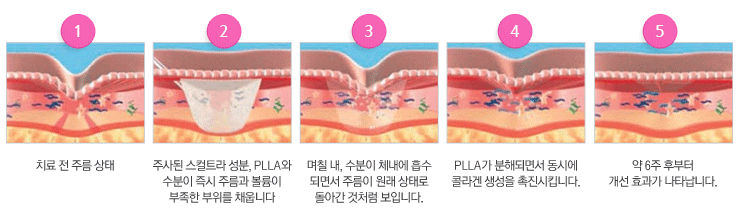 필러 vs 스컬트라, 뭐가 좋은가요? 주름개선 & 꺼진 볼륨 채워주는 시술 정리!_ 닥터 지온