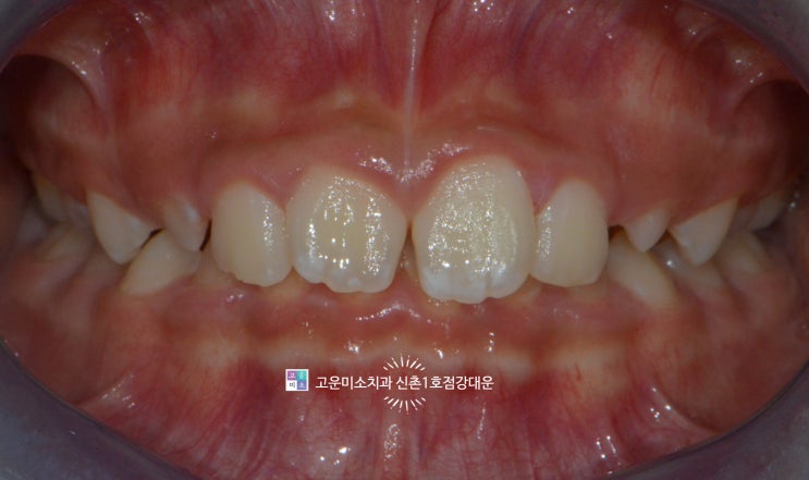  과개교합때문에 아랫니가 안 보여요. (앞니가 깊게 물리고 불규칙합니다.)  [교정]고운미소치과 신촌1호점