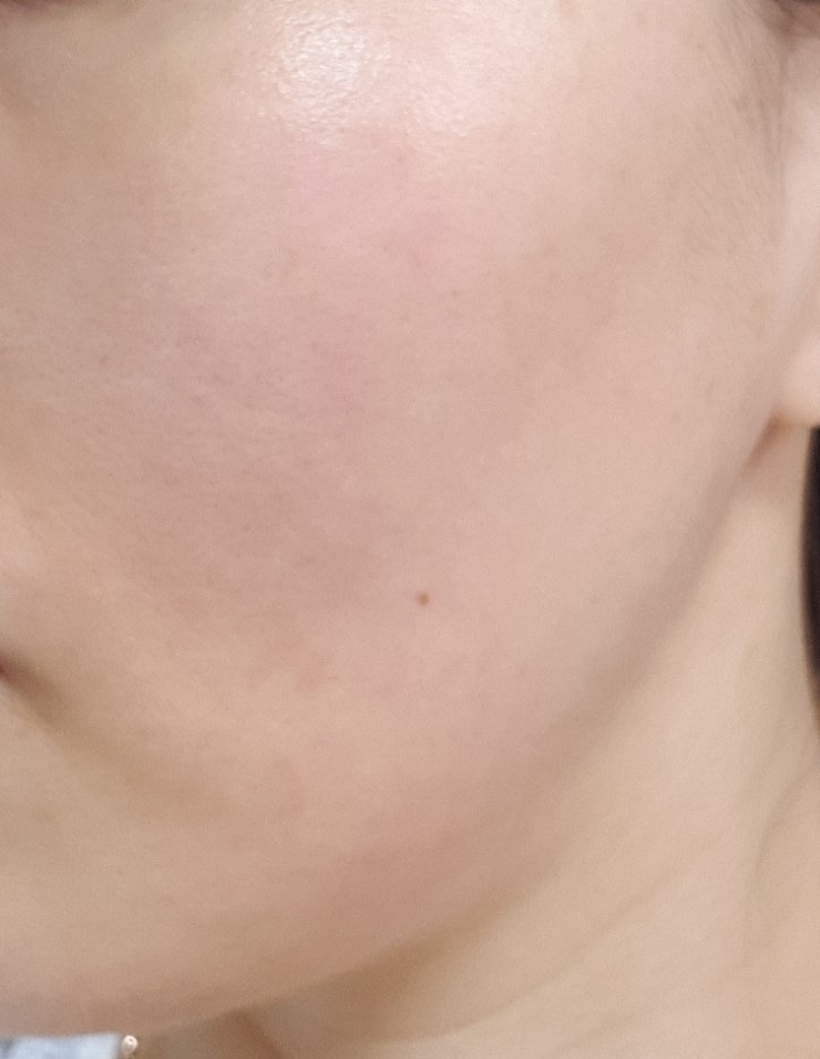  <피부일기> 수란트라 15일차/ 모낭염/ 주사피부염/ 안면홍조/ 지루성피부염/ 날치알염증