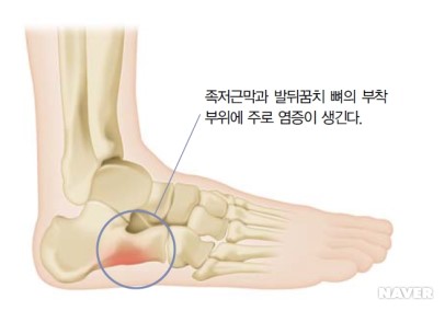  대표적인 발질환 3가지 족저근막염