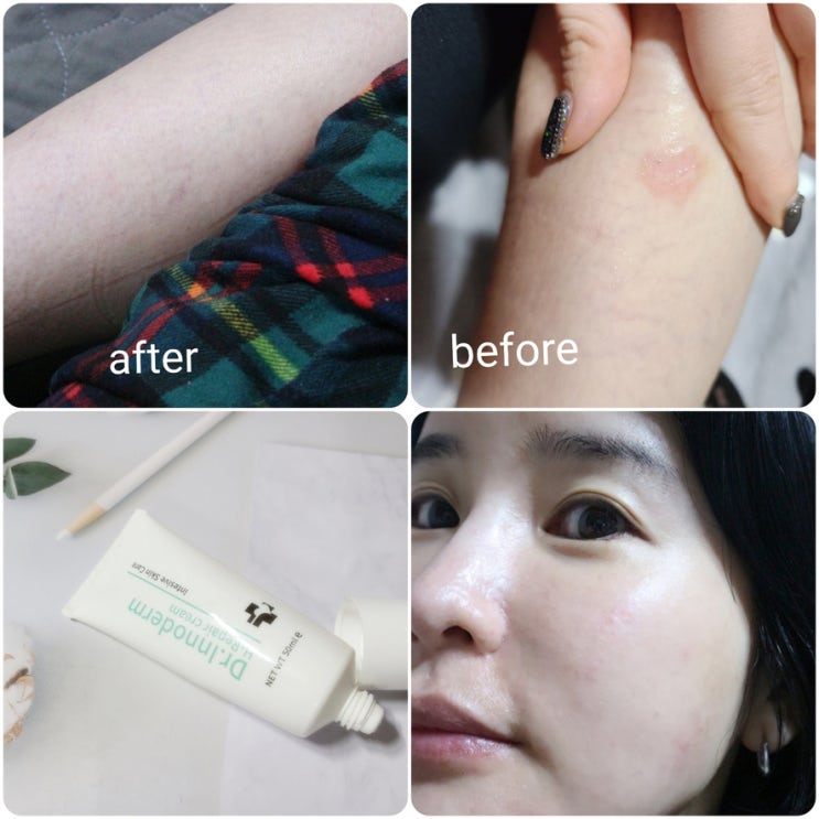 여드름 재생크림 재생연고 얼굴부터 다리 상처까지 이노덤으로 ! 여드름 재생크림 재생연고 얼굴부터 다리 상처까지 이노덤으로 !