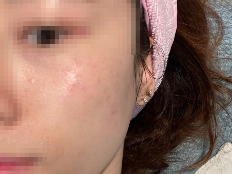  기미꺼져 기미잡티레이저 받으러 압구정 다녀온 썰