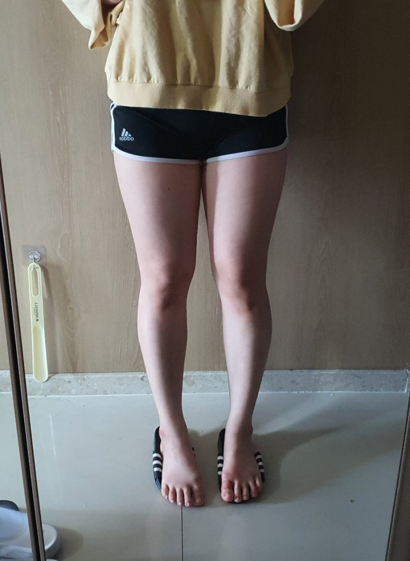 하체비만다이어트 비결은 서면피부과 MPL 주사