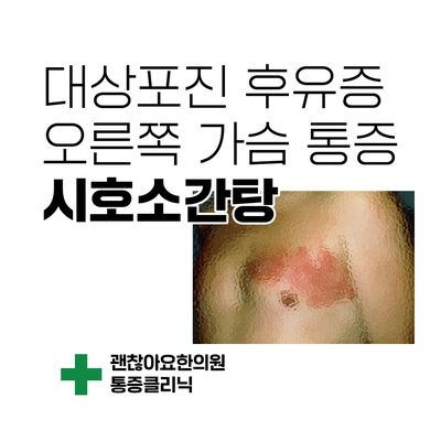 대상포진 후 신경통. 오른쪽 가슴 통증에 시호소간탕 [한방스퀘어 : 통증의 한방치료 4] ②