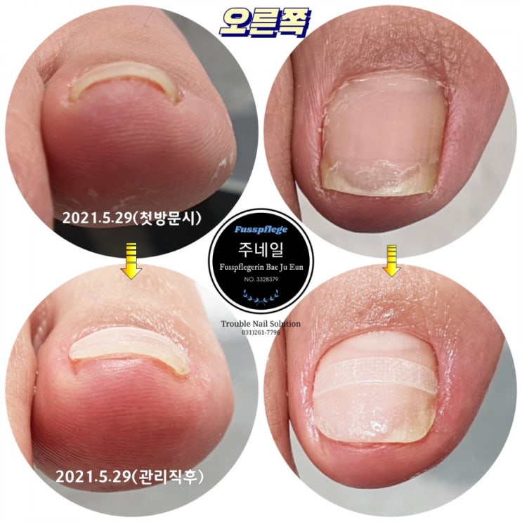 내향성발톱 당일관리후기/성남수원수지보정동백죽전동/주네일/무좀파고드는내향성발톱손톱변형전문점