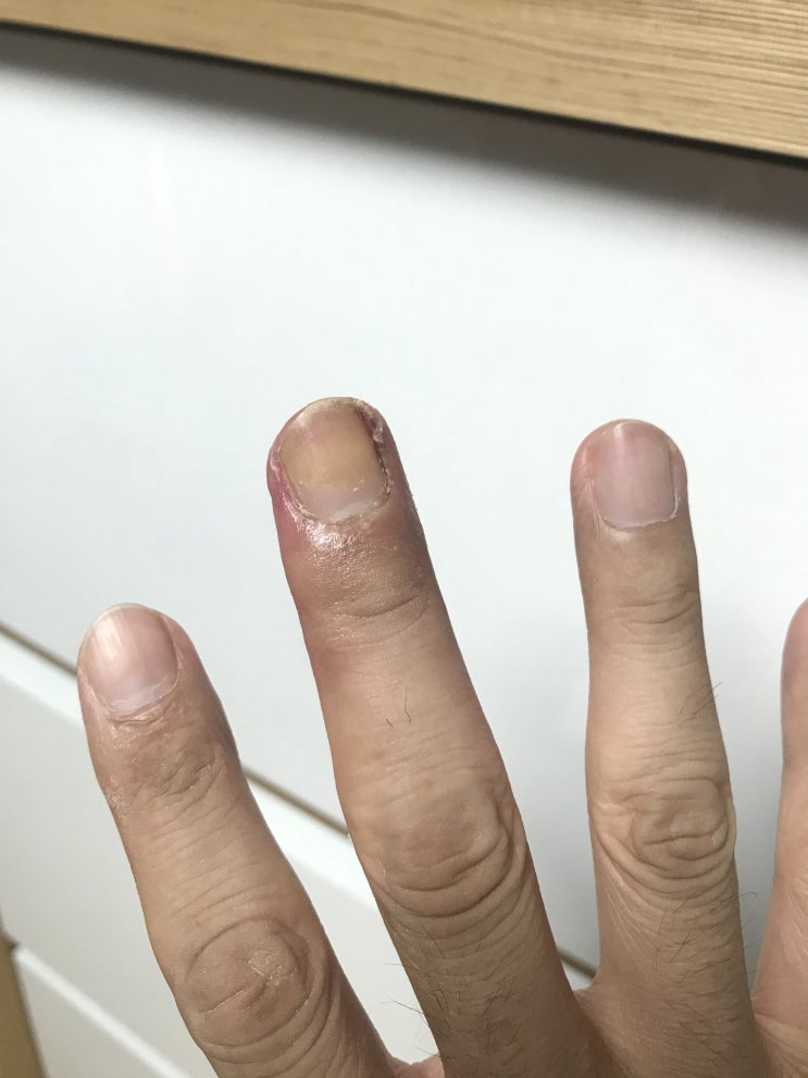 조갑주위염 (생인손) 치료기 3 - 드디어 손가락 보호대를 풀었다!