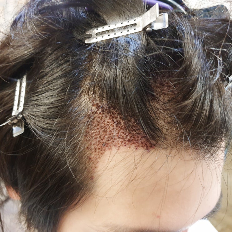  남자앞머리가발 모발이식 후에 써도 되나요?