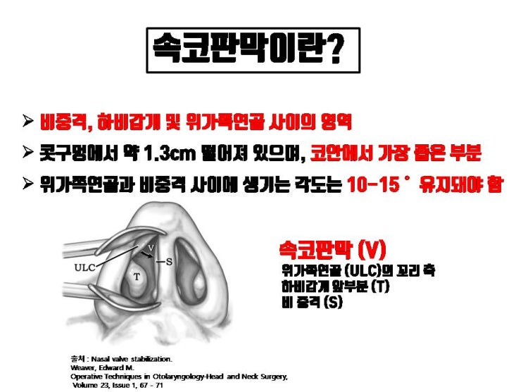  코막힘 증상이 없는데 실비보험 코수술을 받기 위해 비밸부를 수술하면 해부학적 구조를 망가트려 코수술 부작용이 발생할 수 있어요.