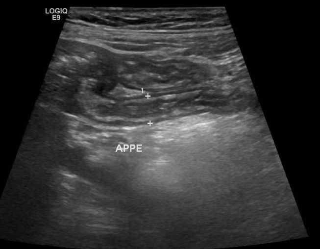 CAUSE, SYMPTOMS AND OPERATION METHOD OF FEMALE INGUINAL organization of the correct treatment process