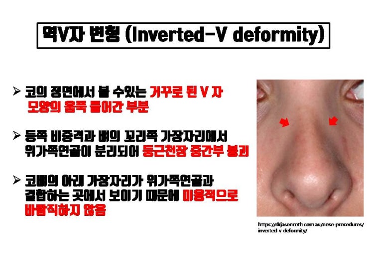  무리한 매부리코 수술, 코절골 코수술 후 역V자 변형 생길 수 있어요!!! 뭐든지 과유불급!!!
