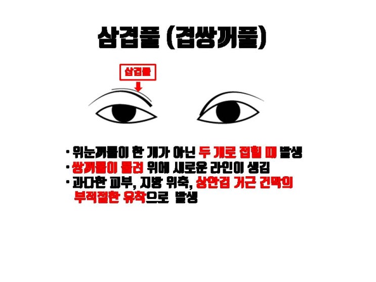  삼겹풀, 삼겹쌍꺼풀, 겹쌍꺼풀로 시행하는 쌍꺼풀절개재수술은 굉장히 어려운 수술이에요!!!