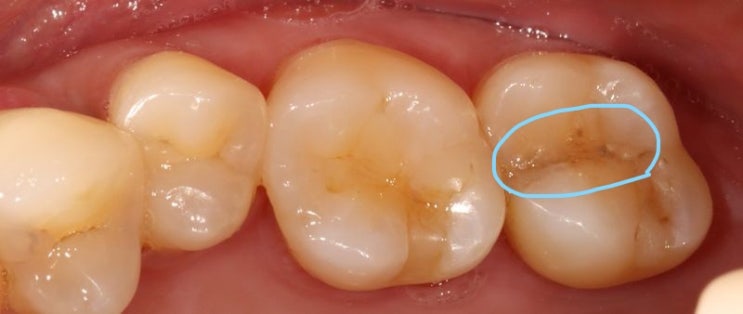 치아 균열 증상 및 치료 (응암역 치과)