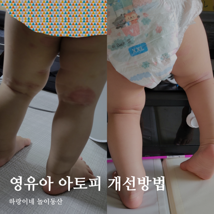 아기 동전습진 개선, 영유아 아토피 보습법과 효과본 제품 Top3