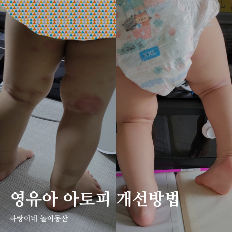  아기 동전습진 개선, 영유아 아토피 보습법과 효과본 제품 Top3