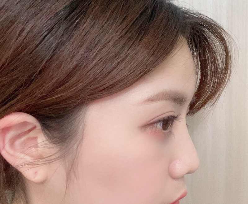 신논현성형외과 강남이마필러잘하는병원 이마필러 입술보톡스 찐 후기!! 8